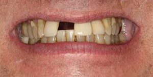 A missing front tooth prior to restoration