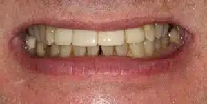 Post-treatment smile following delivery of the final tooth crown supported by a single tooth implant.
