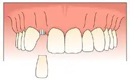 A temporary crown is attached to the single tooth dental implant.