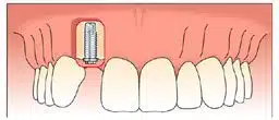 A single tooth implant is inserted to replace a missing tooth.