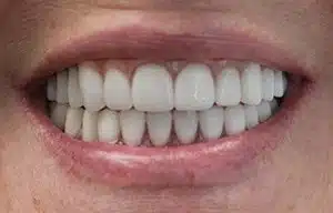 Close-up view of a patient's new smile following delivery of final All-On-4 Upper and lower prostheses.