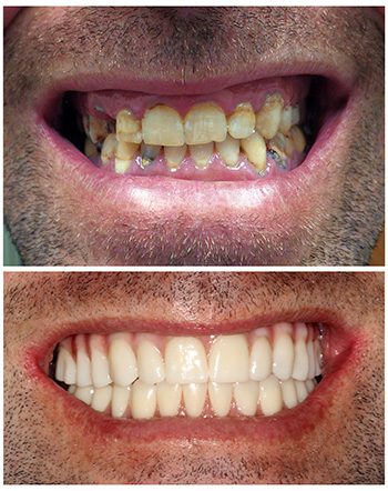 Before and After closeup photos of a patient treated with the All-On-4 Treatment Concept