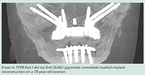 Radiograph of quad zygomatic case