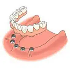 A graphic of a lower dental implant supported prosthesis.