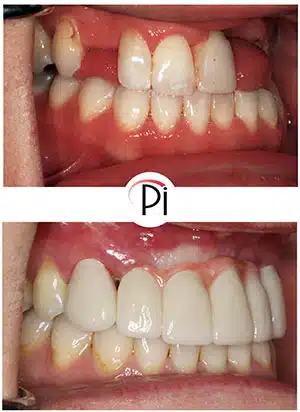 Zirconia crowns and dental implants restored patient's smile.