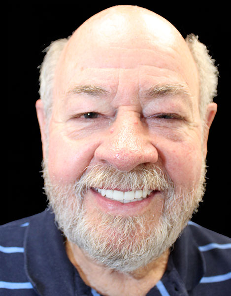 Upper and Lower Dental Implant Restorations