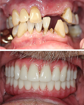 Before and After photos of patient who received All-On-4 Dental Implant Restorations.