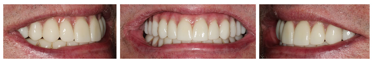 Three close-up views of final teeth supported by 5 dental implants.