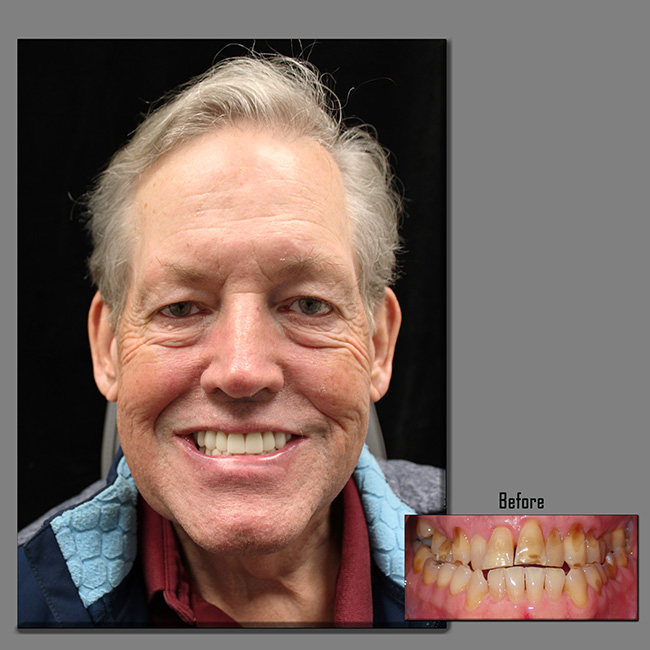 Full-Face photo of a gentleman who received All-On-5 Dental Implants with an inset of before treatment.