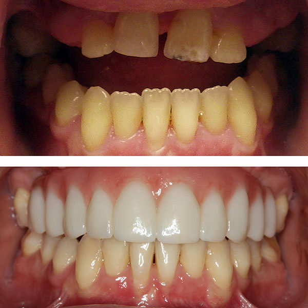 Before and After Intraoral Photos of Patient with All-On-4 Dental Implant Treatment