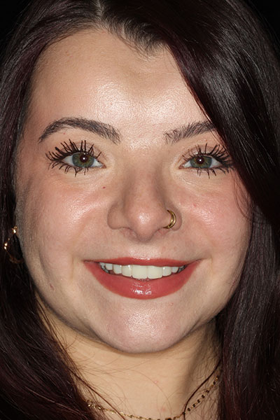 A dazzling smile with All-On-4 Dental Implant Treatment