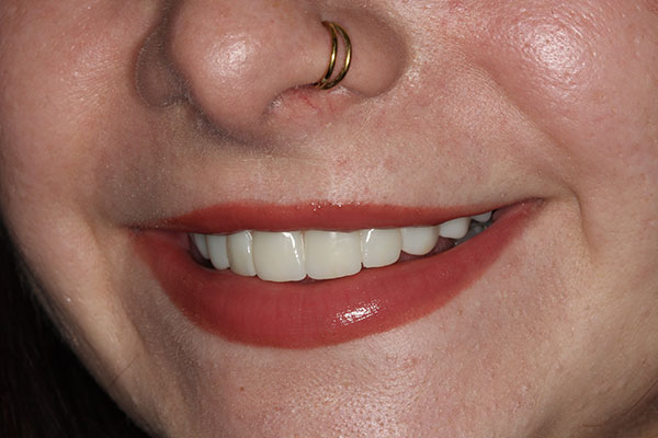 Closeup of post-treatment smile following All-On-4 Treament